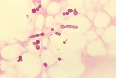 Malassezia furfur